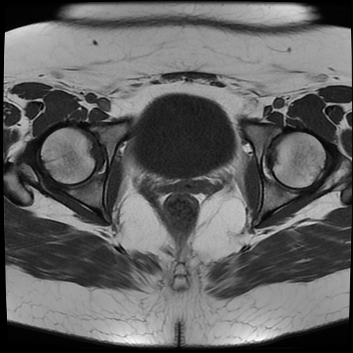 File:Adult granulosa cell tumor of the ovary (Radiopaedia 64991-73953 Axial T1 19).jpg