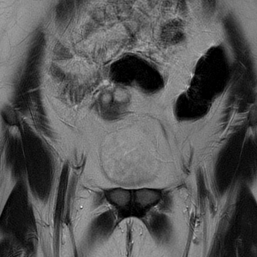 File:Adult granulosa cell tumor of the ovary (Radiopaedia 64991-73953 Coronal T2 3).jpg