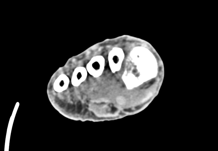 Advanced osteomyelitis due to open metatarsal fracture (Radiopaedia 83891-99095 Axial non-contrast 31).jpg