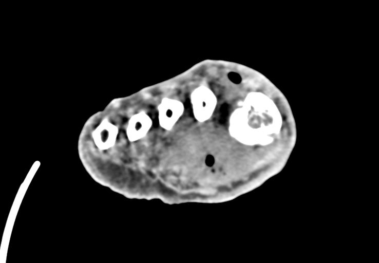 Advanced osteomyelitis due to open metatarsal fracture (Radiopaedia 83891-99095 Axial non-contrast 35).jpg