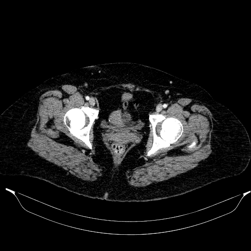Afferent loop syndrome - secondary to incarcerated trocar site hernia (Radiopaedia 82959-97305 Axial C+ portal venous phase 223).jpg