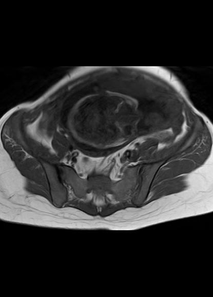 File:Aggressive angiomyxoma of the pelvis and perineum (Radiopaedia 59162-66479 T1 22).jpg