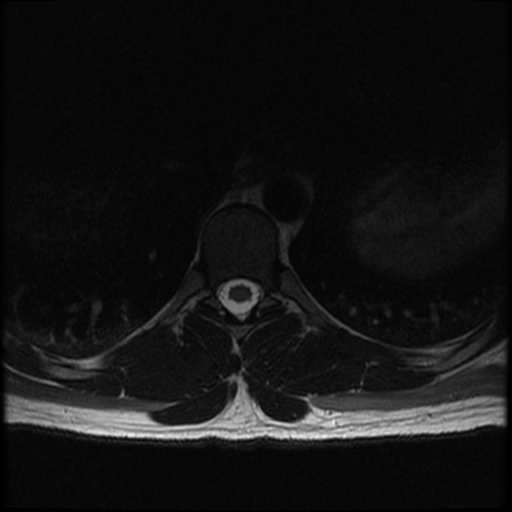 File:Aggressive vertebral hemangioma (Radiopaedia 39937-42404 Axial T2 14).png