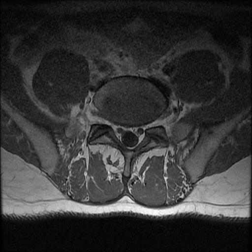 File:Aggressive vertebral hemangioma with pathological fracture (Radiopaedia 69528-79411 Axial T1 C+ 2).jpg