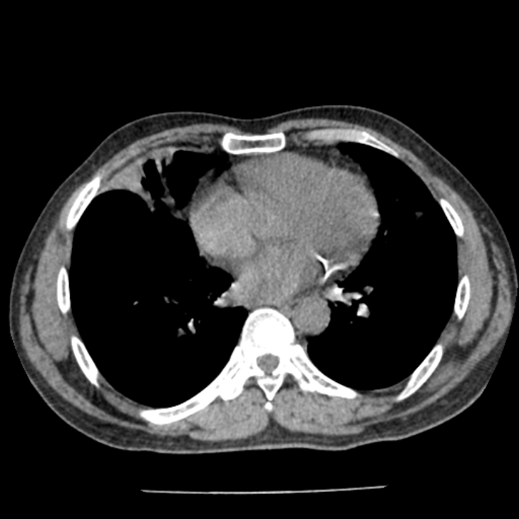 Airway foreign body in adult (Radiopaedia 85907-101779 Axial liver window 118).jpg