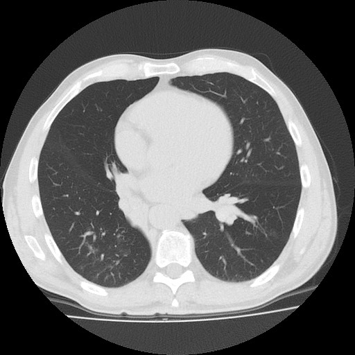 Allergic bronchopulmonary aspergillosis (ABPA) (Radiopaedia 60594-68313 Axial lung window 36).jpg