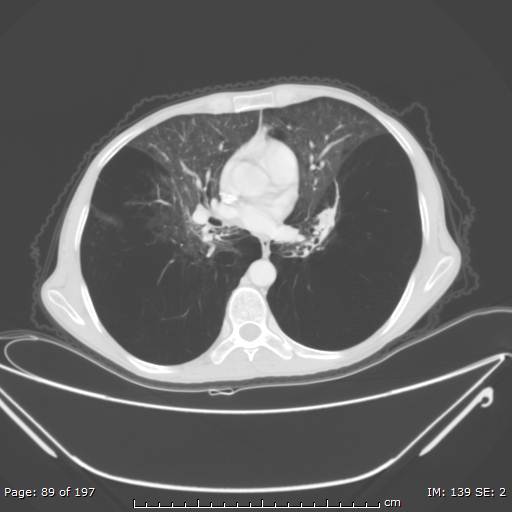 File:Alpha-1-antitrypsin deficiency (Radiopaedia 50561-55987 Axial lung window 38).jpg