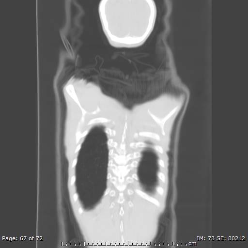 Alpha-1-antitrypsin deficiency (Radiopaedia 50561-55987 Coronal lung window 65).jpg