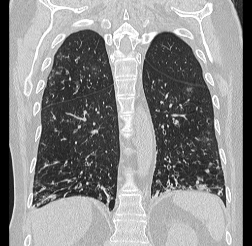 Alpha-1-antitrypsin deficiency (Radiopaedia 72058-82557 Coronal lung window 72).jpg