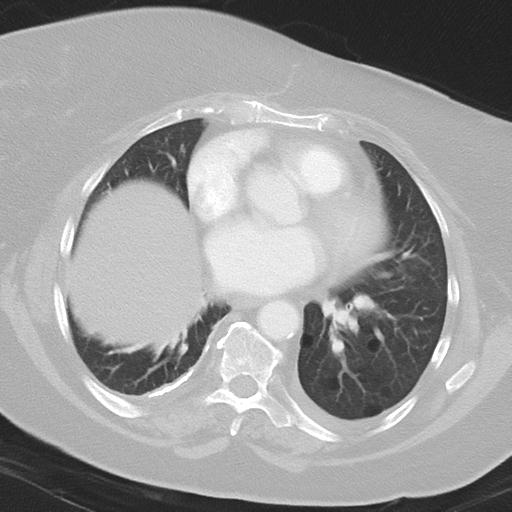 Alveolar hemorrhage and possible lymphocytic interstitial pneumonitis in systemic lupus erythematosus (Radiopaedia 28582-28839 Axial lung window 30).jpg