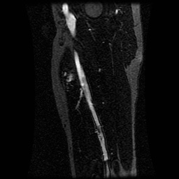 Alveolar soft part sarcoma (Radiopaedia 64501-73678 D 51).jpg