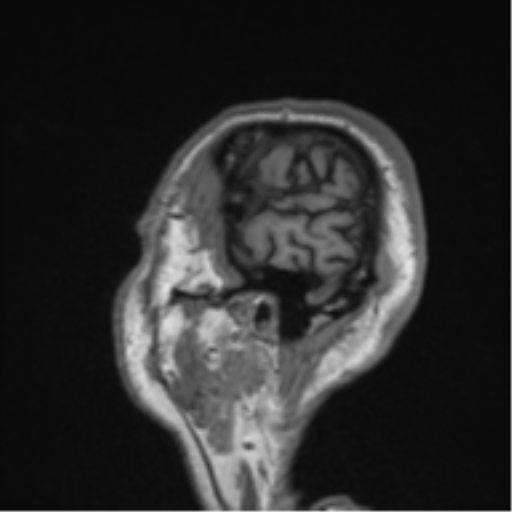 Alzheimer's disease- with Gerstmann syndrome and dressing apraxia (Radiopaedia 54882-61150 Sagittal T1 66).png