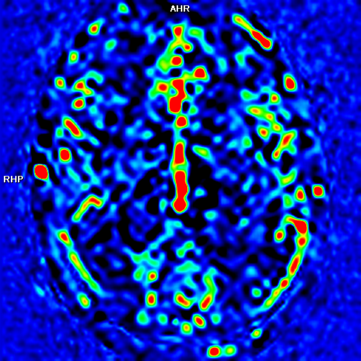File:Alzheimer's disease- with apraxia (Radiopaedia 54763-61011 E 27).png