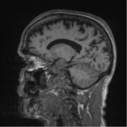 Alzheimer's disease- with apraxia (Radiopaedia 54763-61011 Sagittal T1 44).png