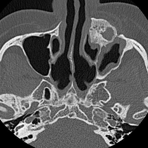 File:Ameloblastic fibro-odontoma (Radiopaedia 18843-18780 C 16).jpg