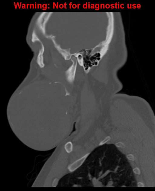 Ameloblastoma (Radiopaedia 33126-34164 Sagittal bone window 22).jpg
