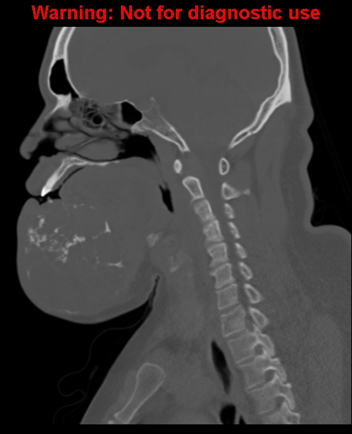 Ameloblastoma (Radiopaedia 33126-34164 Sagittal bone window 38).jpg