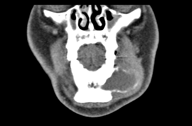 Ameloblastoma (Radiopaedia 33677-34806 Coronal non-contrast 17).png
