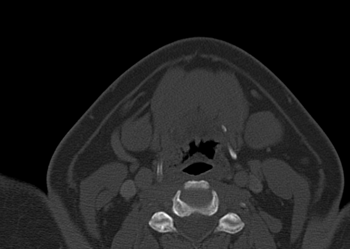 File:Ameloblastoma (Radiopaedia 38520-40623 D 43).png