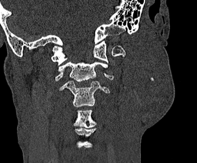 Ameloblastoma (Radiopaedia 51921-57766 Coronal bone window 234).jpg