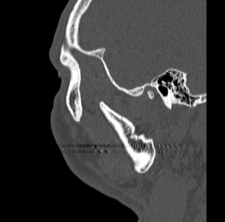 Ameloblastoma (Radiopaedia 77750-89997 Sagittal bone window 104).jpg