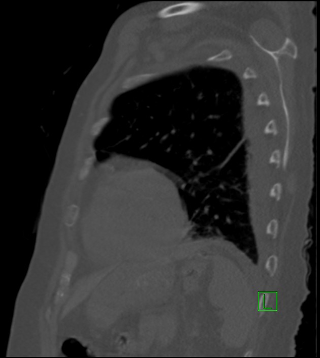 Amiodarone deposition in the liver (Radiopaedia 77587-89780 Sagittal bone window 27).jpg