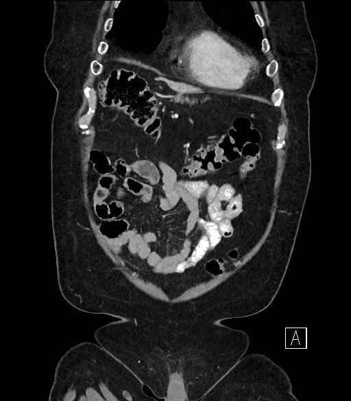 Ampullary adenocarcinoma (Radiopaedia 59373-66734 D 11).jpg