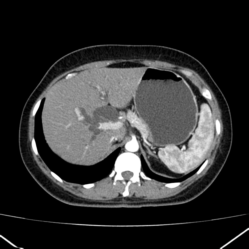 Ampullary tumor (Radiopaedia 22787-22816 B 22).jpg