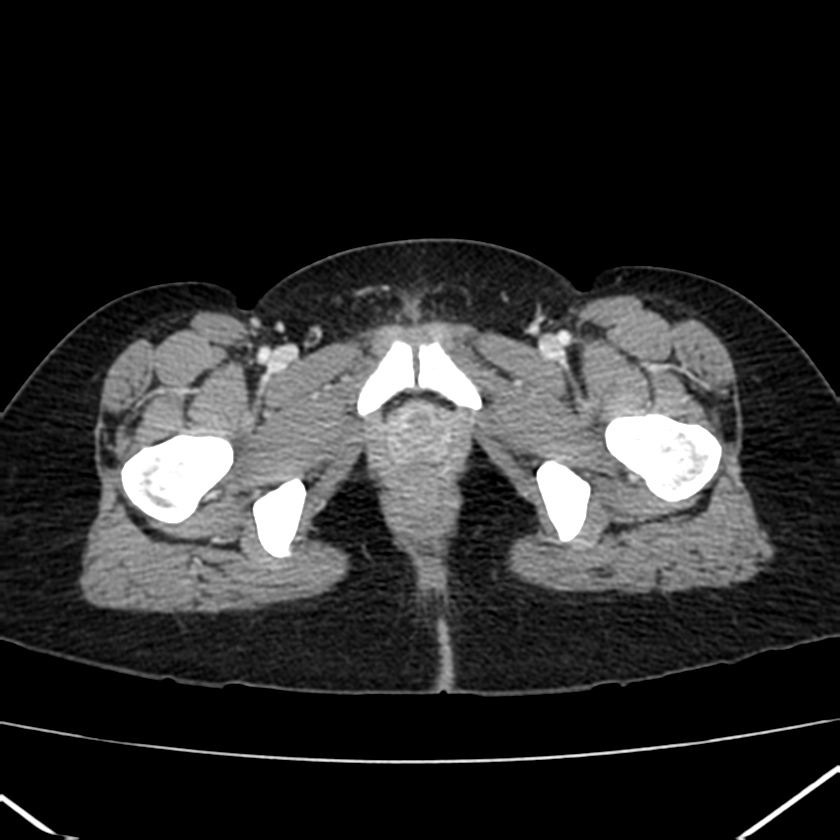 Ampullary tumor (Radiopaedia 22787-22816 C 72).jpg