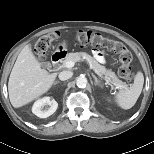 File:Amyand hernia (Radiopaedia 39300-41547 A 19).png