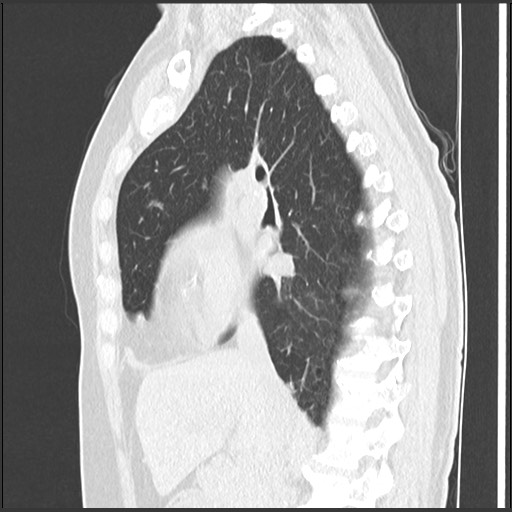 Amyloidosis - bronchial and diffuse nodular pulmonary involvement (Radiopaedia 60156-67744 F 24).jpg