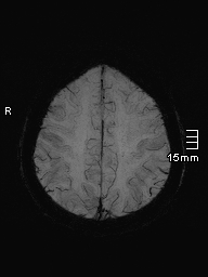 File:Amyotrophic lateral sclerosis (Radiopaedia 70821-81017 Axial SWI minIP 38).jpg