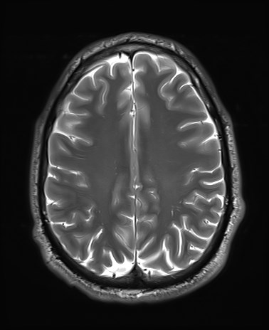 File:Amyotrophic lateral sclerosis (Radiopaedia 87352-103658 Axial T2 21).jpg