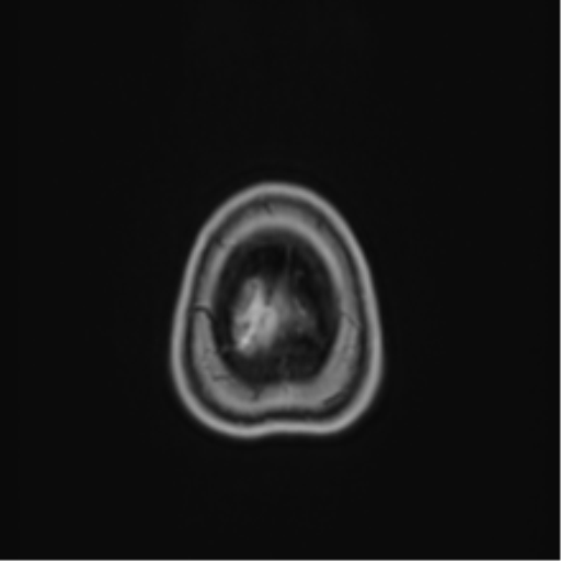 Anaplastic astroblastoma (Radiopaedia 55666-62194 Axial T1 C+ 72).png