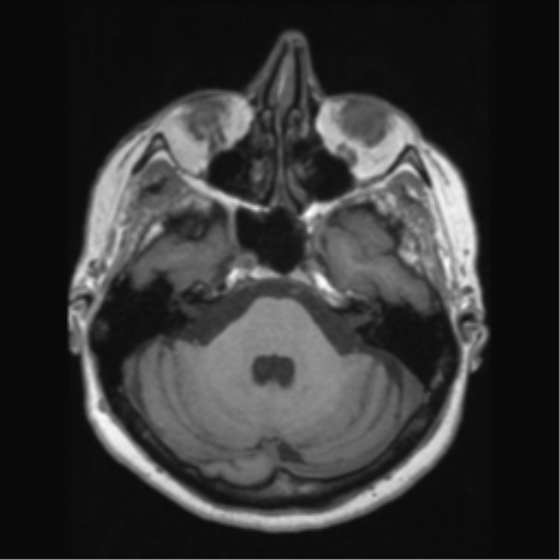 Anaplastic astrocytoma IDH wild-type (pseudoprogression) (Radiopaedia 42209-45276 Axial T1 46).png
