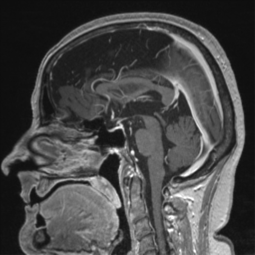 File:Anaplastic astrocytoma IDH wild-type (pseudoprogression) (Radiopaedia 42209-45276 Axial T1 C+ 153).png