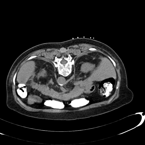 File:Anaplastic lymphoma - with CT biopsy (Radiopaedia 21643-21602 Axial non-contrast 14).jpg