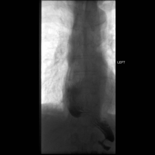 File:Anastomotic stricture post Ivor Lewis esophagectomy (Radiopaedia 47937-52715 C 12).png