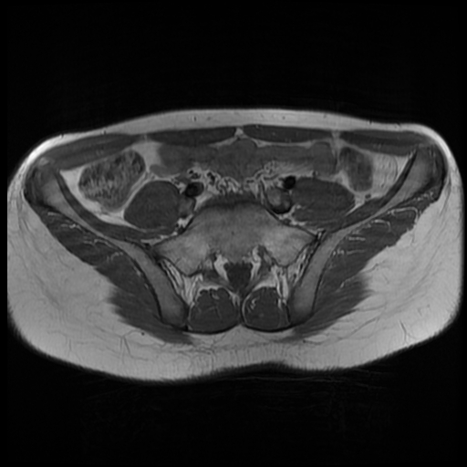 File:Androgen insensitivity syndrome (Radiopaedia 38585-40727 Axial T1 1).jpg