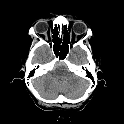 Aneursym related subarachnoid hemorrhage with hydrocephalus (Radiopaedia 45105-49083 Axial non-contrast 8).jpg