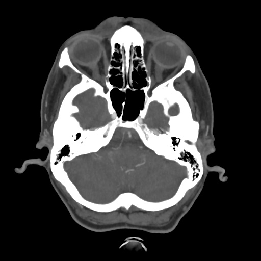 Aneursym related subarachnoid hemorrhage with hydrocephalus (Radiopaedia 45105-49084 A 12).jpg