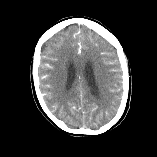 Aneursym related subarachnoid hemorrhage with hydrocephalus (Radiopaedia 45105-49084 D 35).jpg