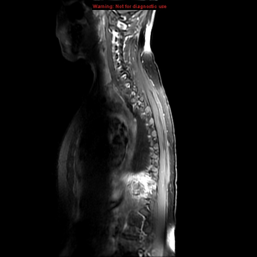 File:Aneurysmal bone cyst (Radiopaedia 9419-10103 Sagittal T1 fat sat 10).jpg