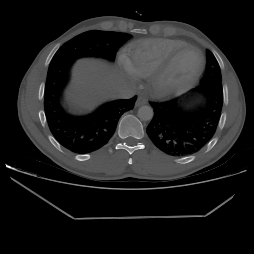 Aneurysmal bone cyst - rib (Radiopaedia 82167-96220 Axial bone window 194).jpg