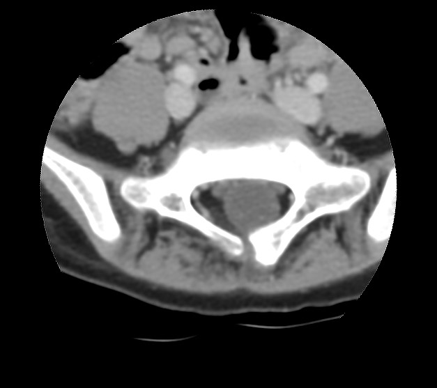 Aneurysmal bone cyst - sacrum (Radiopaedia 65190-74195 Axial non-contrast 15).jpg