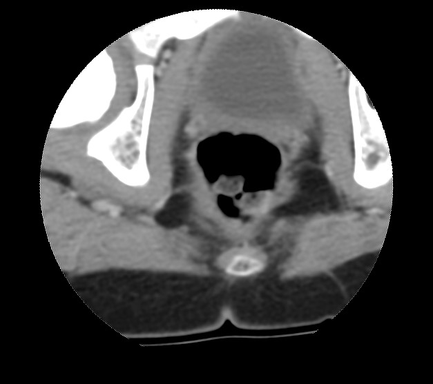 File:Aneurysmal bone cyst - sacrum (Radiopaedia 65190-74195 Axial non-contrast 49).jpg