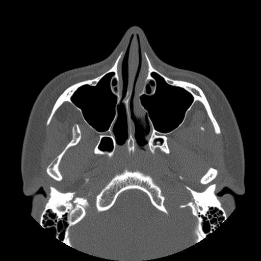 Aneurysmal bone cyst of the mandible (Radiopaedia 43280-46823 Axial bone window 132).jpg