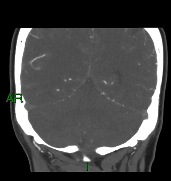 Aneurysmal subarachnoid hemorrhage with intra-axial extension (Radiopaedia 84371-99732 C 30).jpg
