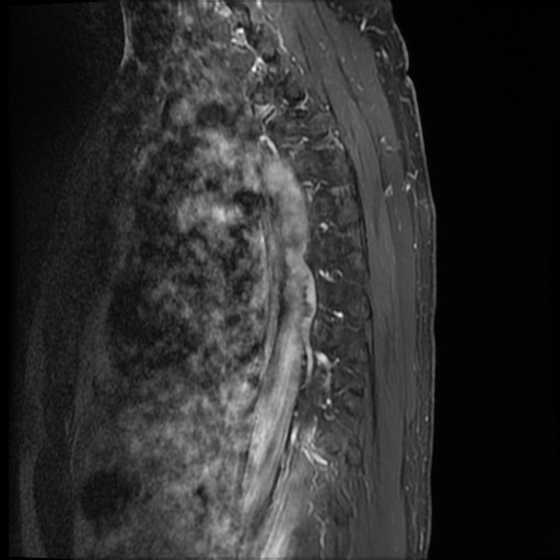 File:Angiolipoma - thoracic spine (Radiopaedia 28242-28479 E 2).jpg