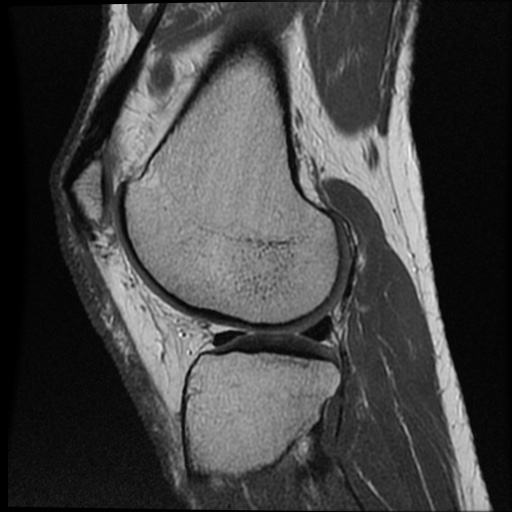 Anomalous insertion of the medial meniscus (Radiopaedia 77559-89721 Sagittal PD 18).jpg